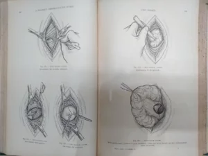 LA PRATIQUE CHIRURGICALE ILLUSTREÉ fascículos VI VII VIII
